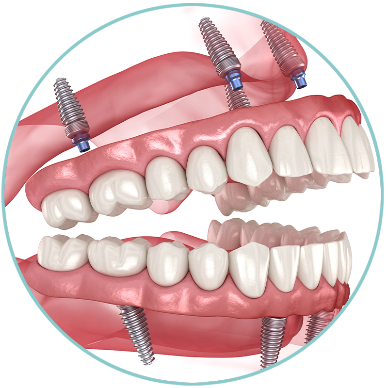 all on 4 implants