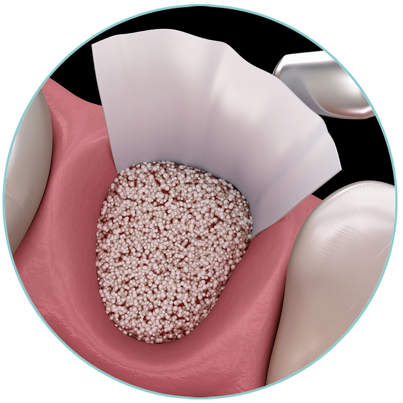 bone grafting 3d