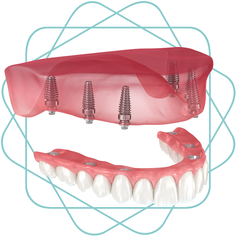 fullmouthimplantcutout