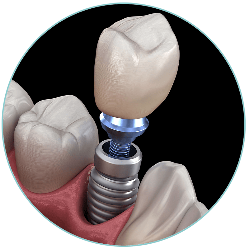 implant 3d model