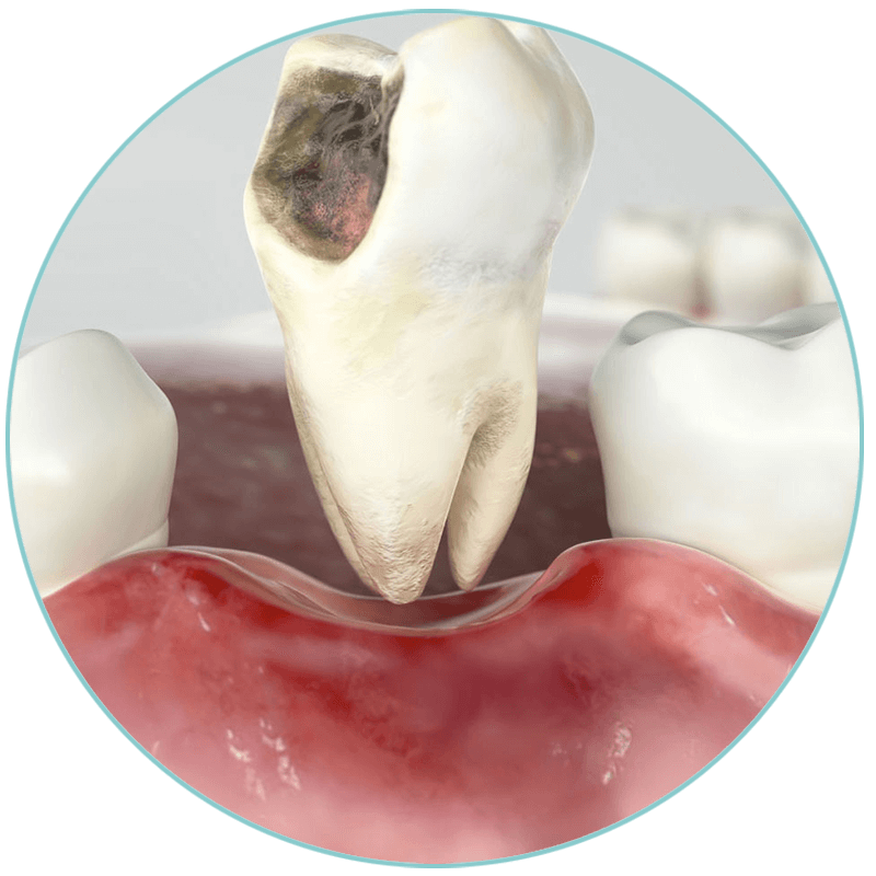 tooth extraction 3d